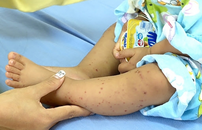 Nhiều bệnh truyền nhiễm tăng nhanh mùa nắng nóng